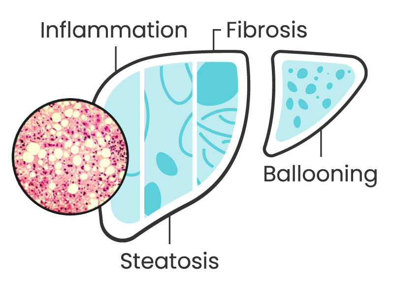 Liver disease diagram showing Steatosis, Inflammation, Fibrosis, and Ballooning