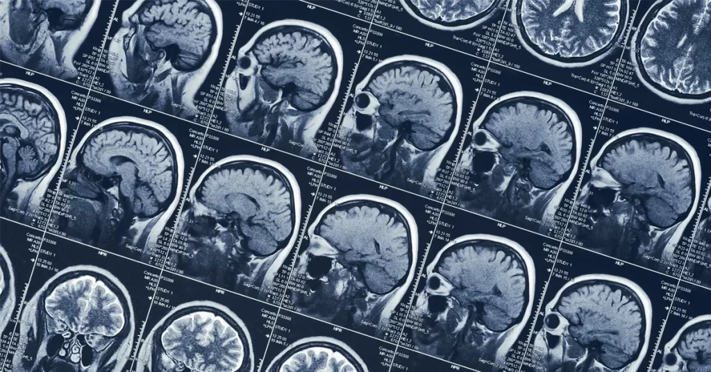 GNPC Neurodegeneration Proteomics Dataset - SomaLogic